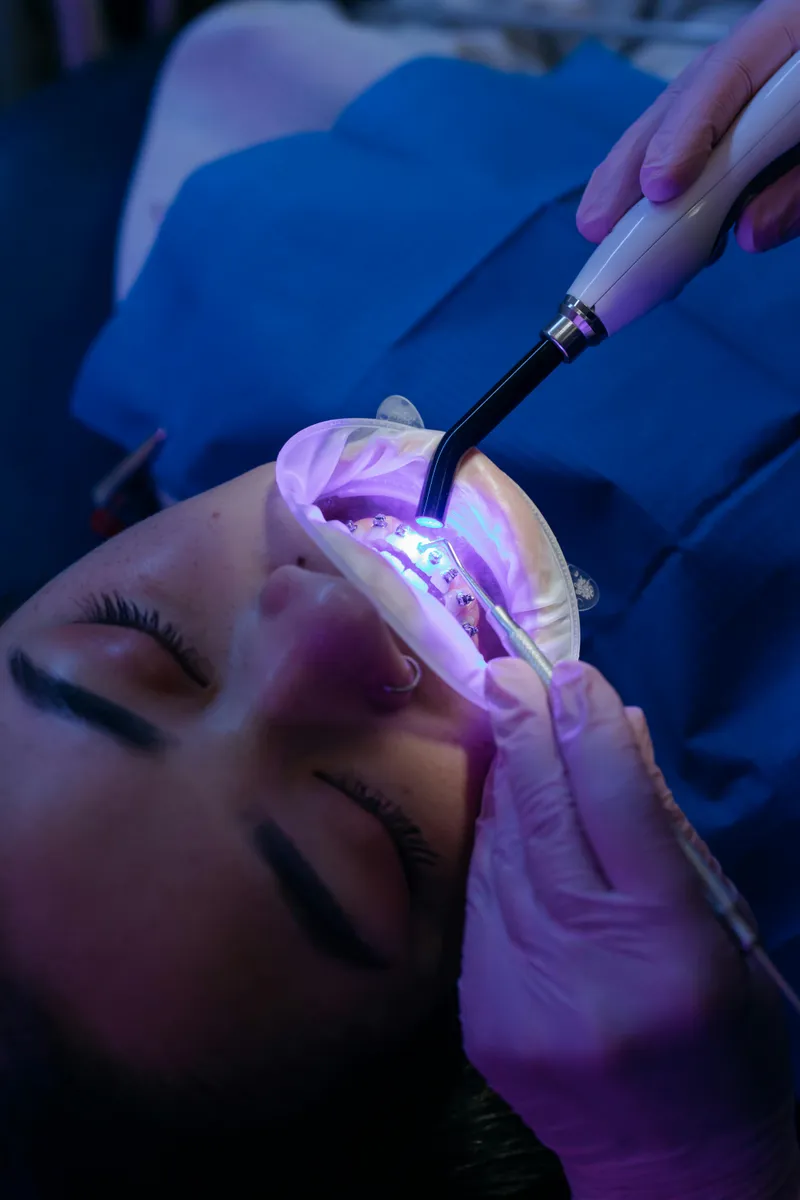 Teeth whitening
