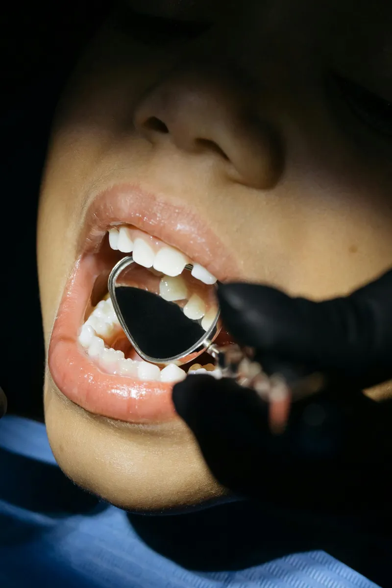 Fissure sealing with sealants