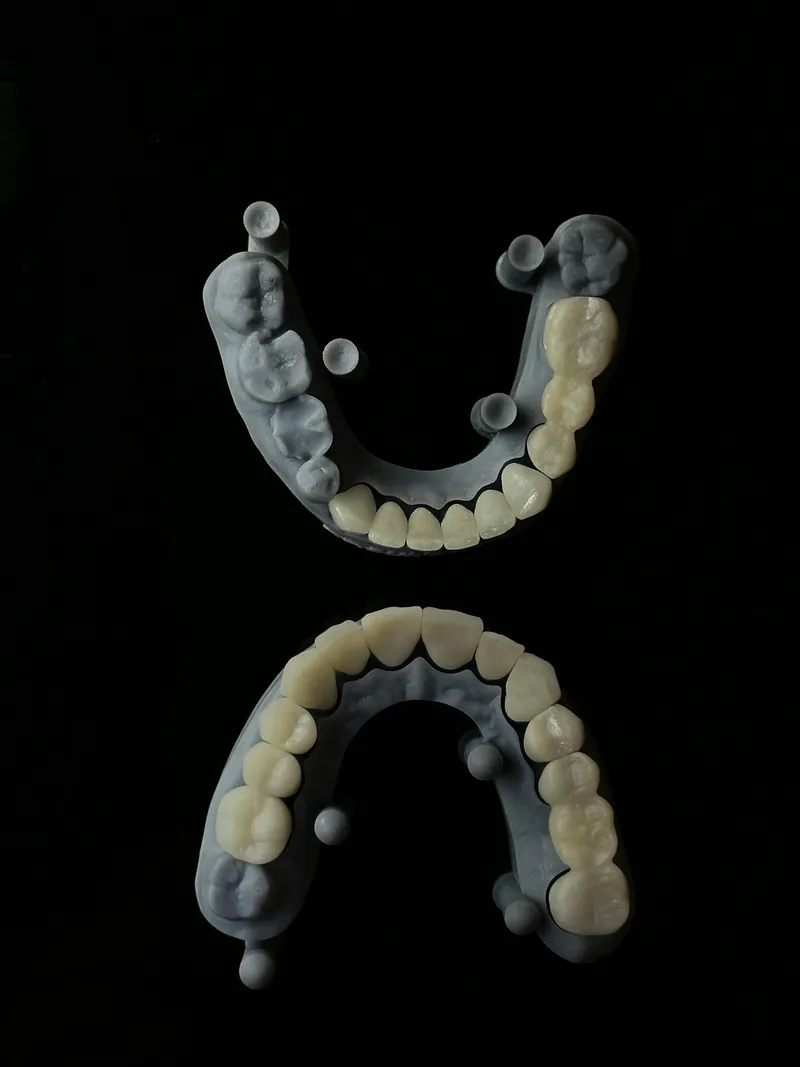 Aesthetic fillings — restoration